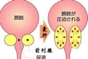 前列腺囊肿问题