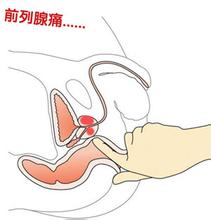 前列腺痛