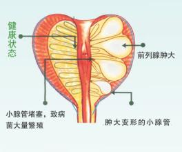 前列腺炎问题