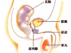 前列腺炎
