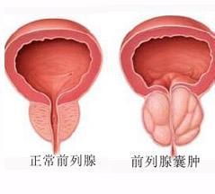 前列腺囊肿
