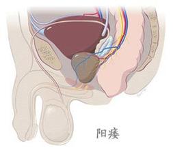 勃起功能障碍