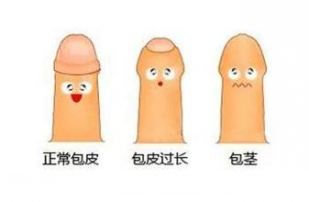 包皮过长