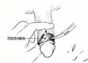 包皮手术