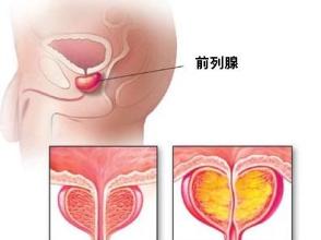 男性前列腺炎