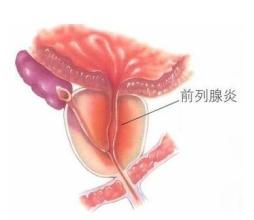前列腺炎问题