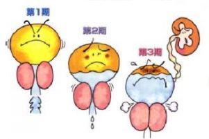 前列腺增生