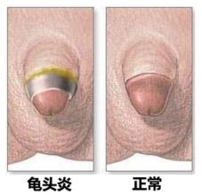 龟头炎问题