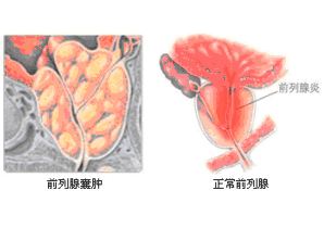 前列腺囊肿