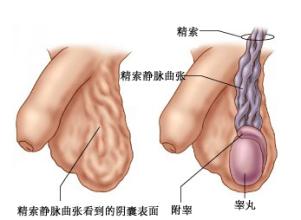 睾丸囊肿