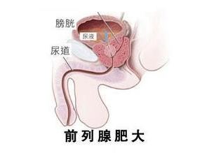前列腺肥大