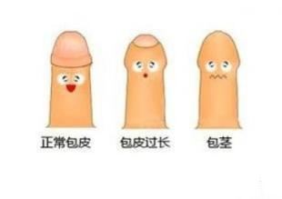 包皮过长