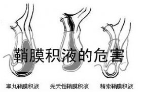 鞘膜积液对人体造成的损害有哪些