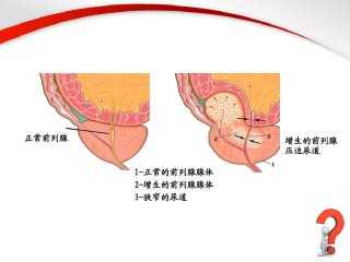 前列腺增生有什么症状